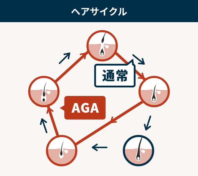 ミノキシジル外用薬とは